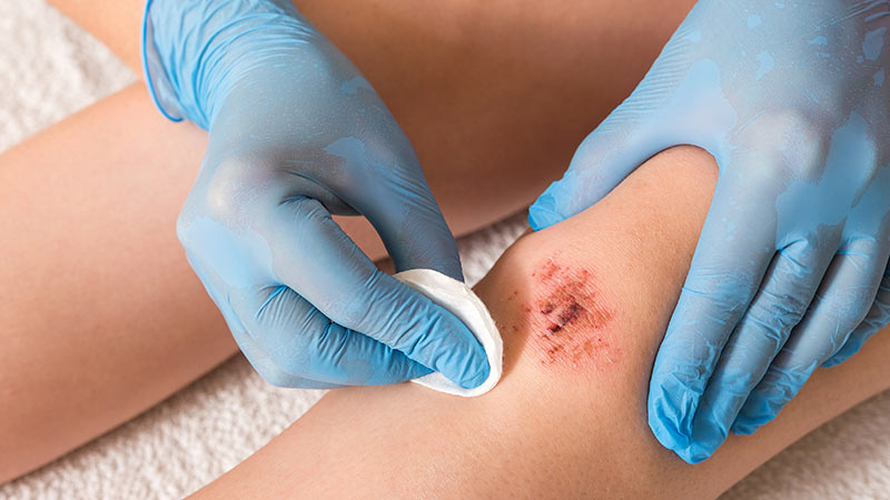 Mãe a aplicar antissético numa ferida do filho